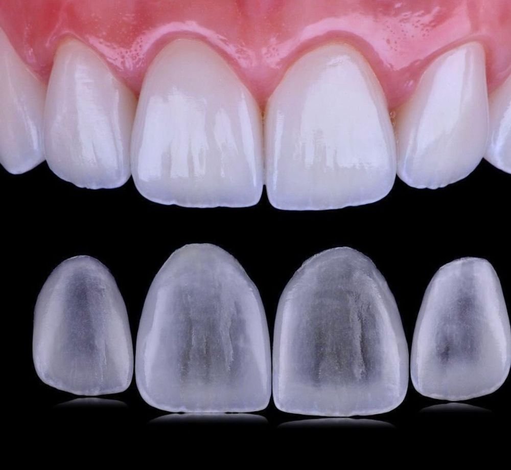Dental Veneers