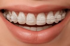 Ceramic Orthodontic Braces